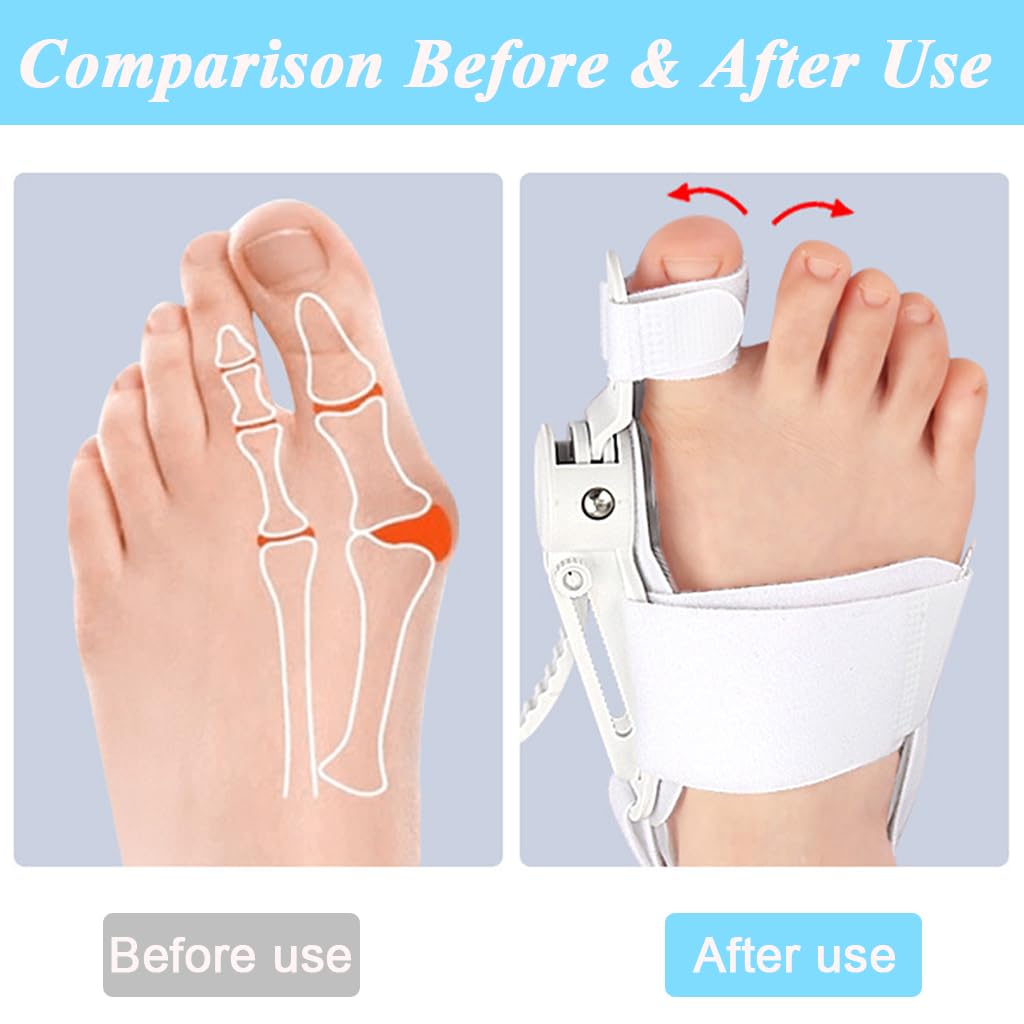 Feet Bunion Corrector/مصحح إبهام القدم