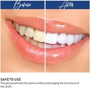 20 MINUTE DENTAL WHITE/جهاز تبيض الأسنان